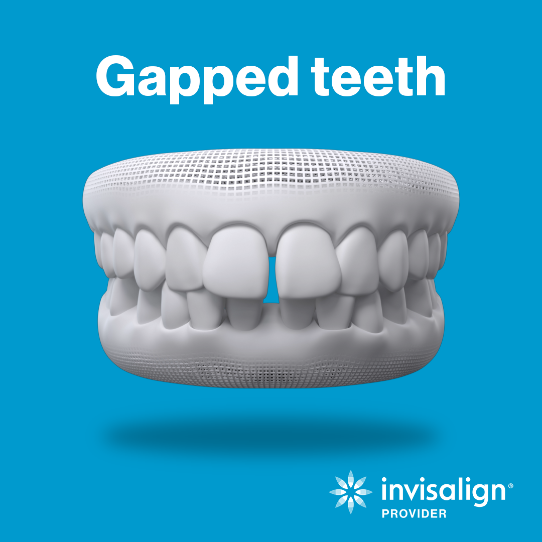 Gapped_teeth